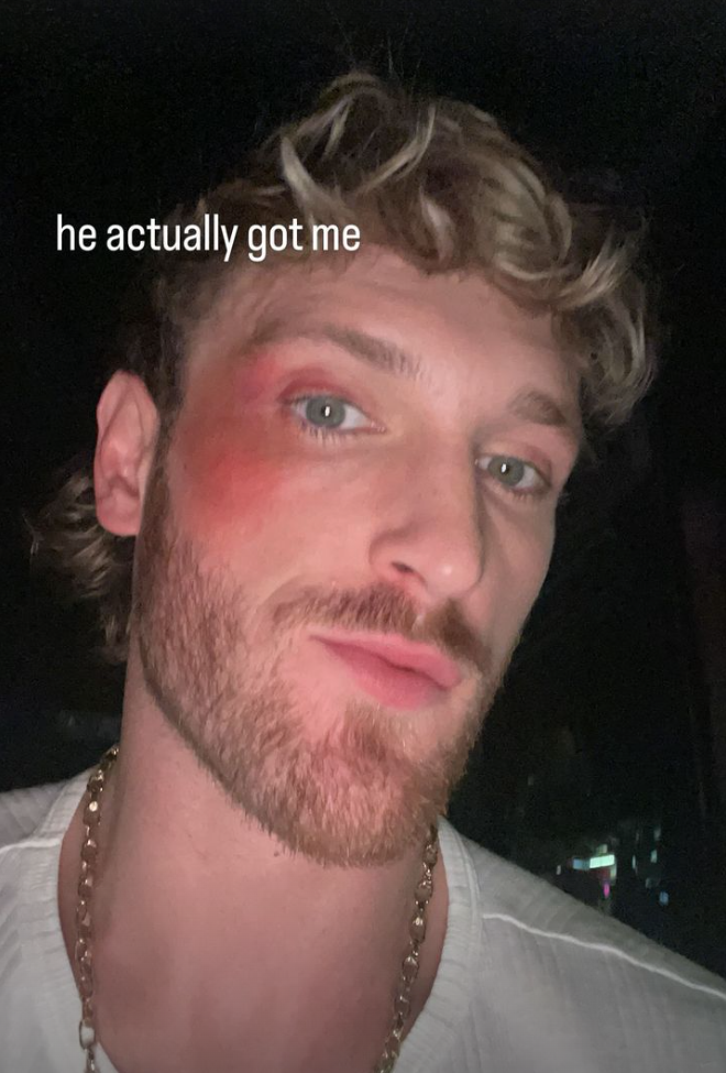 logan-paul-face-bruise-instagram.png